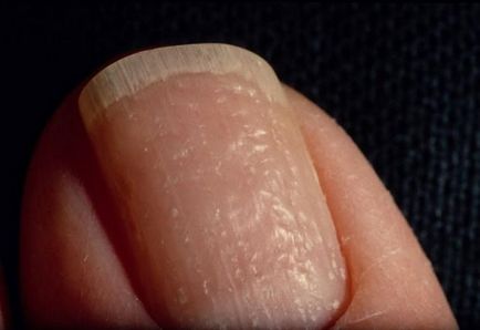 De ce unghiile departe de cauzele pielii și tratarea unghiilor