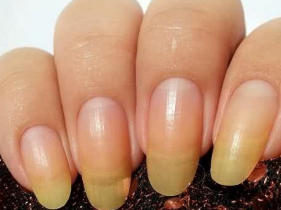 De ce unghiile departe de cauzele pielii și tratarea unghiilor