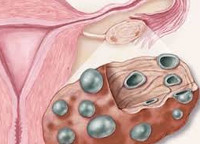 Polichistic ovarian - cauze, simptome, diagnostic și tratament
