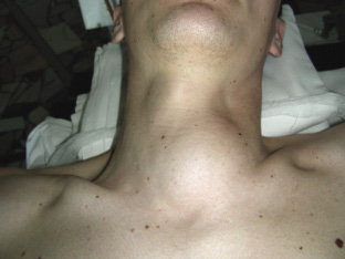 Umflarea în gât la stânga, dreapta, față și spate - alegerea medicului
