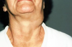 Umflarea în gât la stânga, dreapta, față și spate - alegerea medicului