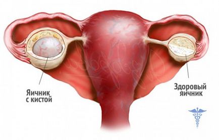 Simptomele ovarian ruptură chist și efecte