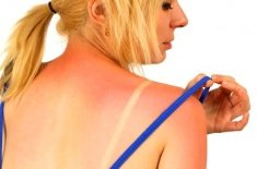 Tratamentul arsurilor solare și de prim ajutor pentru arsuri la soare, precum și pentru tratarea arsurilor solare decât