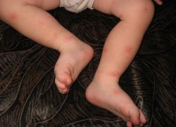 Mușcături de țânțari un copil