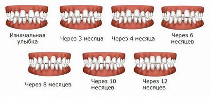 între paranteze dinți de aliniere înainte și după rezultate cu fotografii, recenzii de medici și pacienți