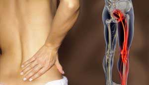 Tratamentul pentru remedii sciatica populare