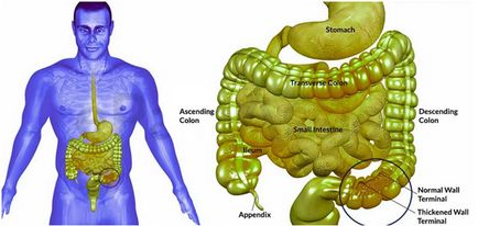 tratamentul bolii intestinului