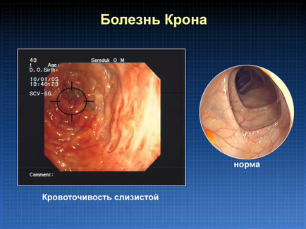 tratamentul bolii intestinului