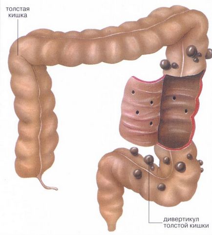 tratamentul bolii intestinului