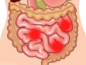 tratamentul bolii intestinului