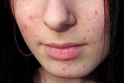 Cum de a vindeca acnee
