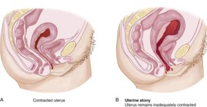 Cum să taie uterului