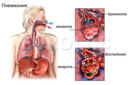 Inflamarea plămânilor care fac