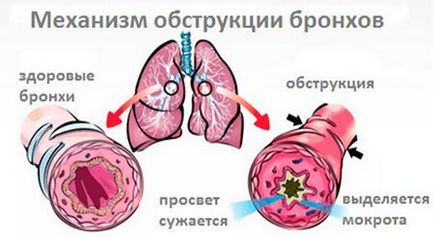 Ce este obstrucție bronșică