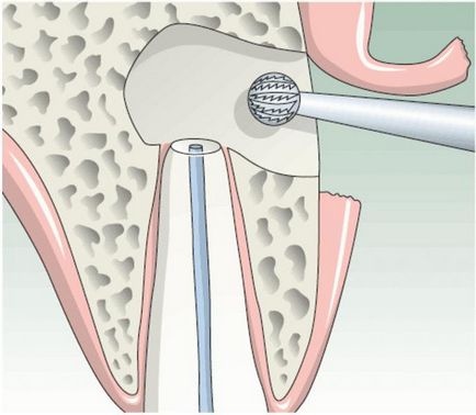 cistectomie ce