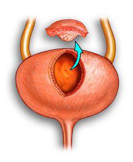 cistectomie ce