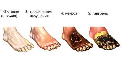 Diabetici Foot Care