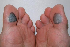 Diabetici Foot Care