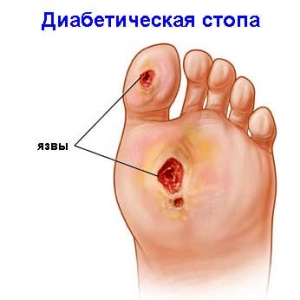 Diabetici Foot Care