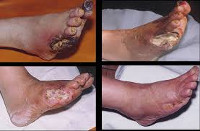 Diabetici Foot Care