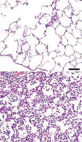 Ce este pneumonia congestiv