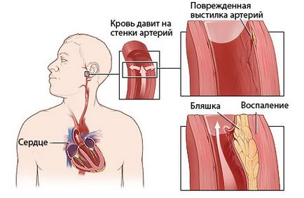 hipovolemia-l