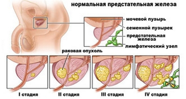 Prostatita și droguri sale de tratament