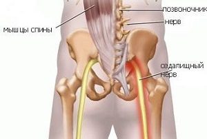 Tratamentul pentru remedii sciatica populare