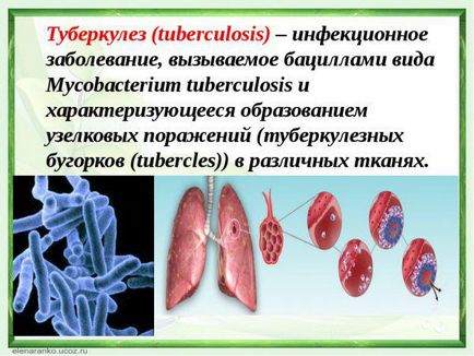 Tratamentul tuberculozei la domiciliu