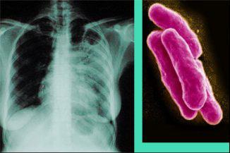 Tratamentul tuberculozei la domiciliu