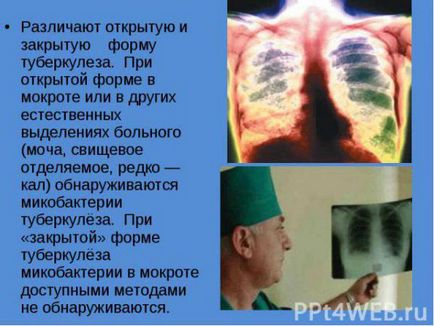 Tratamentul tuberculozei la domiciliu