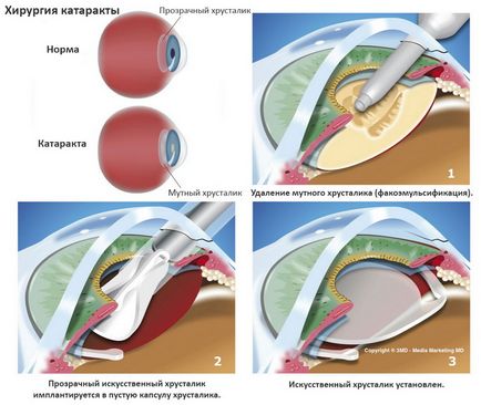 Ce fel de cataracta bolii