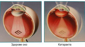 Ce fel de cataracta bolii