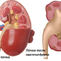 Tratamentul de remedii populare pielonefrite cronice