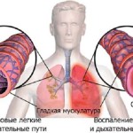 Metodele tradiționale de tratament al bronșitei