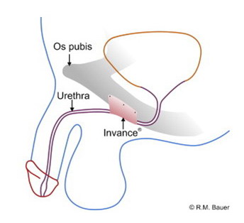 Tratamentul incontinenței urinare la barbati