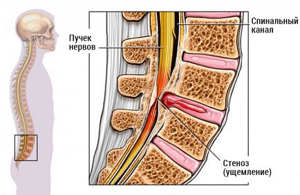 Ce este stenoza spinarii