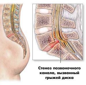 Ce este stenoza spinarii