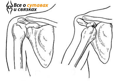 Cum de a reduce un umăr