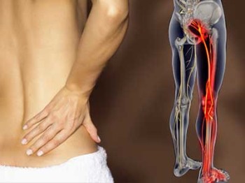 Tratamentul pentru remedii sciatica populare