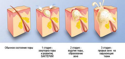 Cum de a vindeca acnee