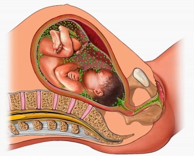 Chlamydia si sarcina de tratament