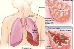 Ce este pneumonia congestiv