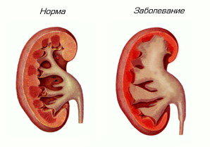 Ce este boala de rinichi