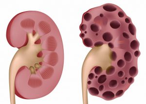 Ce este boala de rinichi