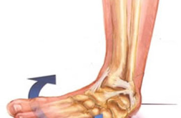 Ce să faci când entorse picior se întinde mușchii și tendoanele ale simptomelor, tratamente
