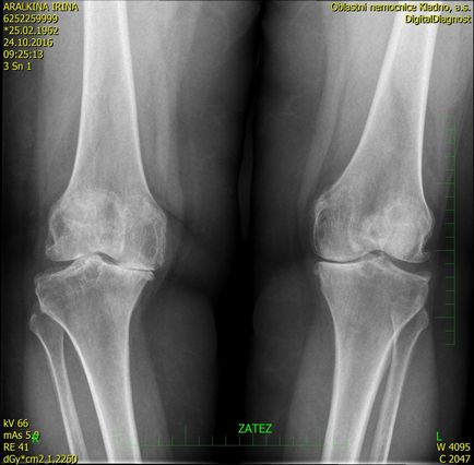 artroplastie de genunchi în cadrul contingentului de la Moscova