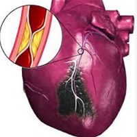 infarct miocardic, stentare coronariană