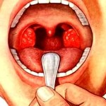 Cum să eliminați rapid o durere în gât