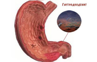 Gastroduodenit cum de a vindeca